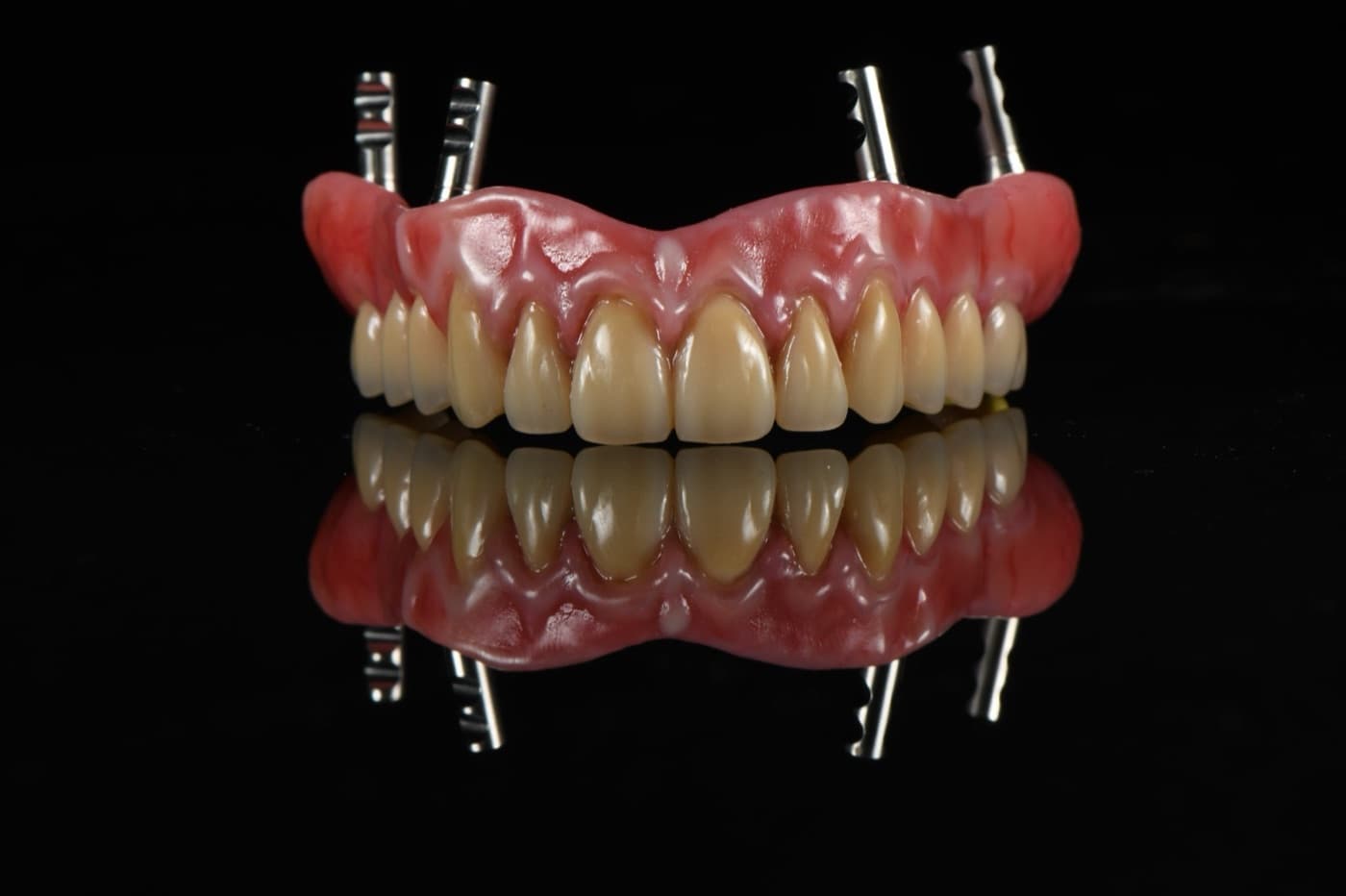 Prothèse complète sur implants