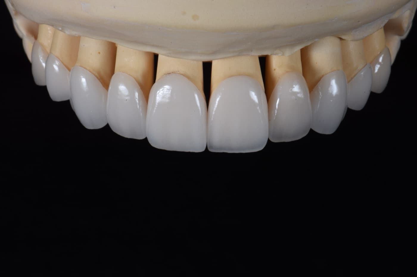 Facettes céramique sur modèle — travail Opal Dental Lab