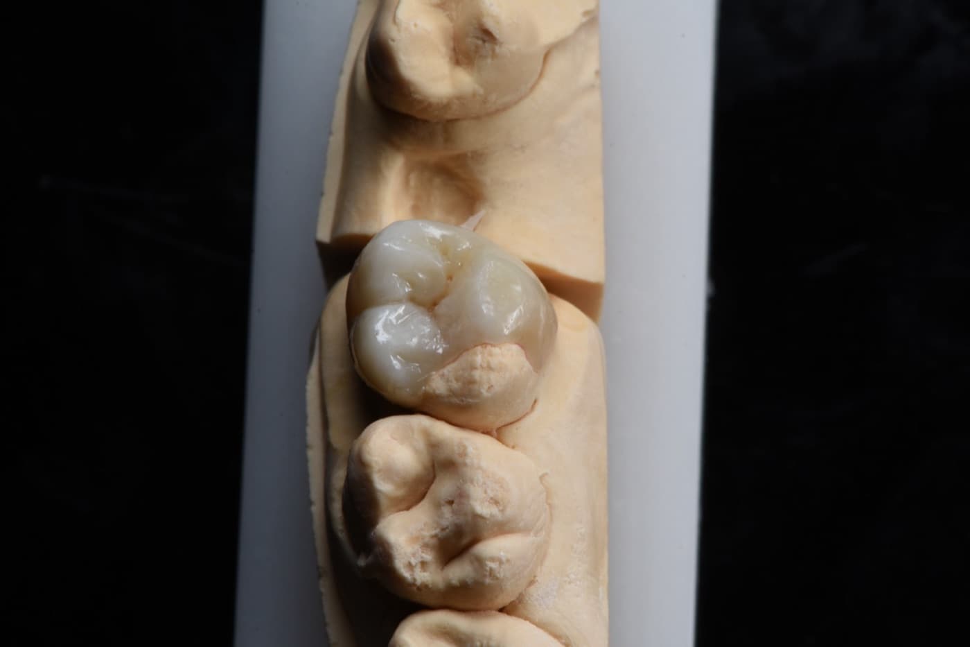 Inlays / Onlays